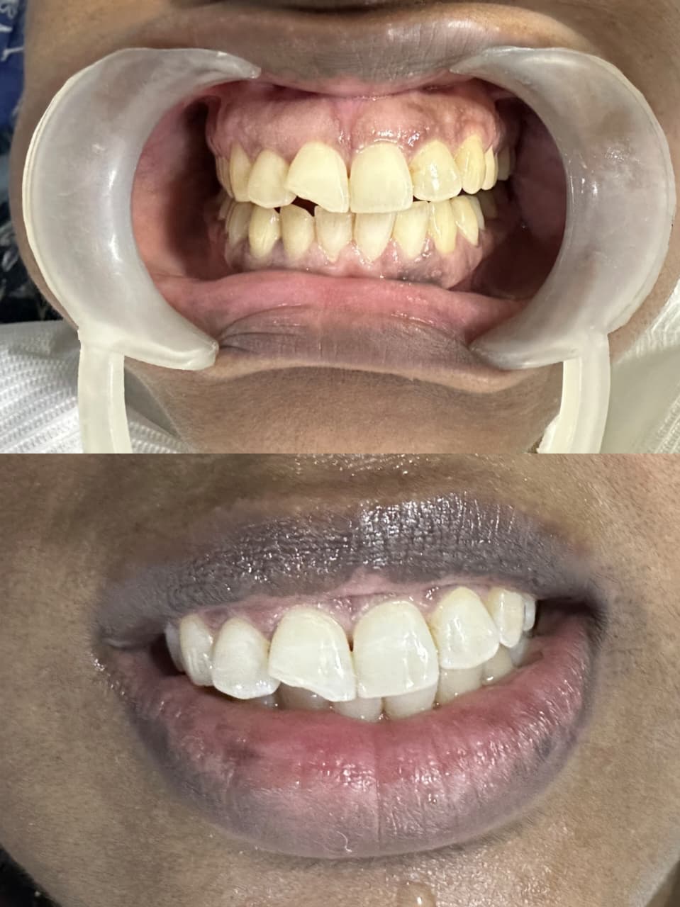 Esthetic Smile Correction